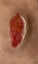 Skin tear wond model 