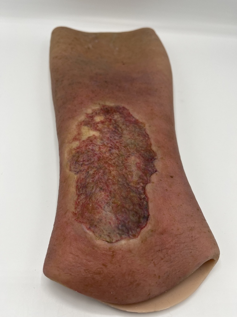 Wondmodel Veneuze Ulcera