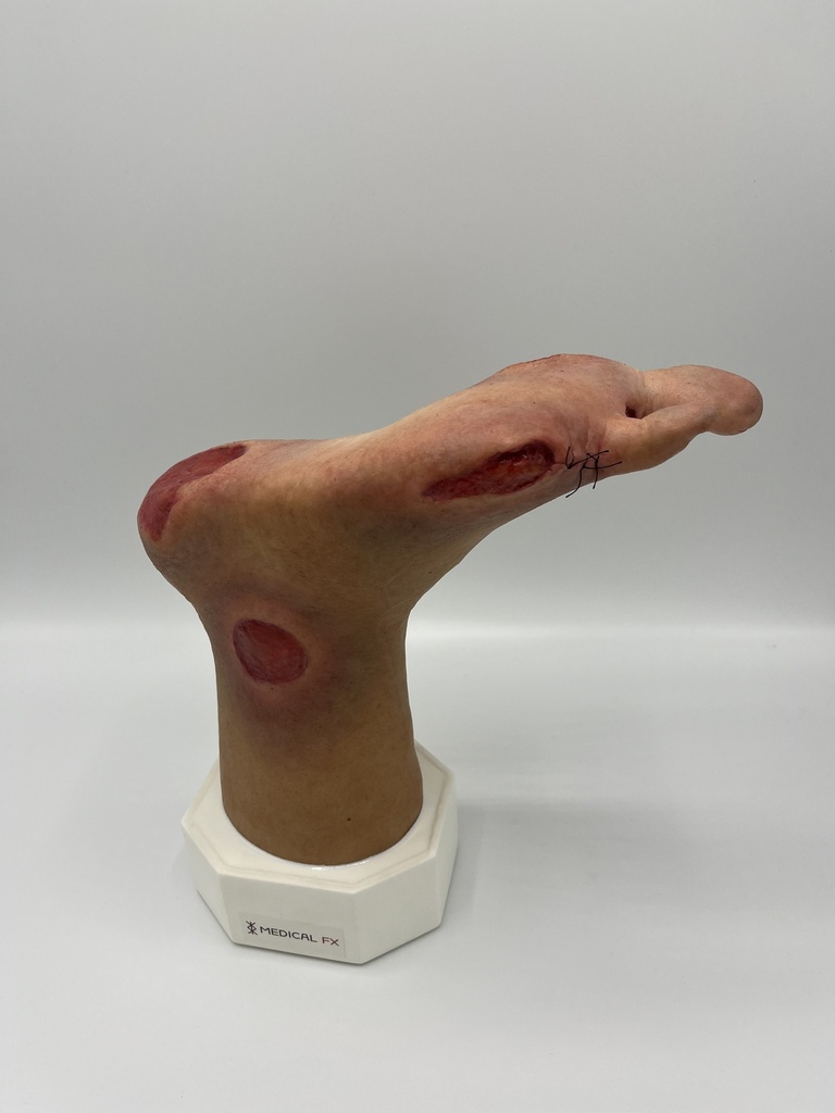Wondmodel Diabetisch voet 